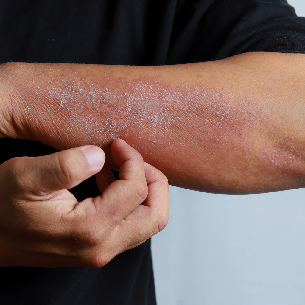 CBD may help for Eczema and Psoriasis